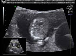 Ultrasonido Gemelos 13 Semanas 2 Youtube