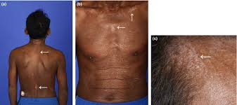 Image result for Diffuse Hyperpigmentation