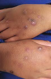 Image result for Papular urticaria