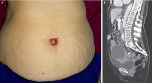 Also known as the umbilical dip piercing and navel piercing, belly button piercing ranks at the top of all popular body piercings. A Lump Grew Out Of A Woman S Belly Button It Was Cancer Live Science