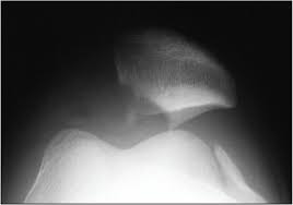 Image result for Ballottable Patella Sign