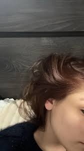 How to treat and get rid of dandruff?