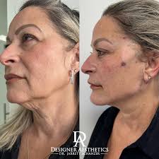 Neck Lift & Décolleté
