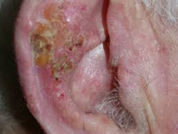In most cases, cancerous lumps are red and firm and sometimes turn into ulcers, while cancerous patches are usually flat and scaly. Squamous Cell Carcinoma Of The Ear Images Dermnet Nz