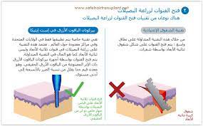 Pin On كم يكلف زرع الشعر في تركيا
