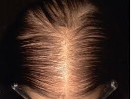 Hair loss in women shows signs very gradually and usually starts with increased shedding before any visible thinning is noticed. Female Pattern Hair Loss Dermnet Nz