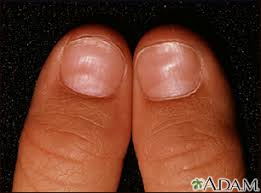 Horizontal ridges are often a sign of an underlying condition that requires. Nail Abnormalities Information Mount Sinai New York