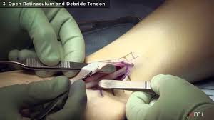 If the peroneal retinaculum is torn due to any injury, then the peroneal tendons move out of their place and slip over the lateral malleolus on the external part of the ankle. Transcript For Peroneal Tendon Debridement Journal Of Medical Insight