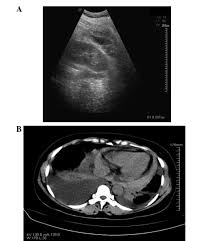 Ultrasound guidance decreases complications and improves the cost of care among patients undergoing thoracentesis and. Post Operative Pericardial Effusion Following Treatment Of Small Hepatocellular Carcinoma With Radiofrequency Ablation A Case Report