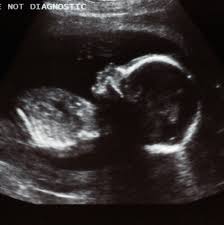 Not all babies will get the hiccups, yet others will get it is extremely rare for cancer to originate there. Baby Was Infected With Coronavirus In Womb Study Reports The New York Times