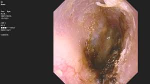 イヤホンが原因の「外耳炎」～耳がかゆい・痛い・腫れる・耳だれ・耳閉感～【こんな症状はありませんか？】 | にしおぎ耳鼻咽喉科クリニック【公式】