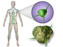 Leukemia is cancer of the blood. Lymphoma Physiopedia