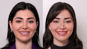 Marcus Medical: Subtle, Natural Results: A Patient's Deep Plane Lip Lift  Transformation