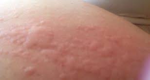Image result for dermatitis contacta allergica