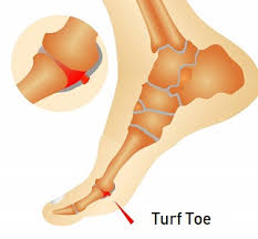 It is a common sports injury, particularly among football and soccer players who play on artificial turf. Turf Toe Injury Causes Diagnosis Treatment Foot Pain Exp