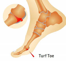 Turf toe injuries occur when the joint of the big toe gets forced into hyperextension. Turf Toe Injury Causes Diagnosis Treatment Foot Pain Exp