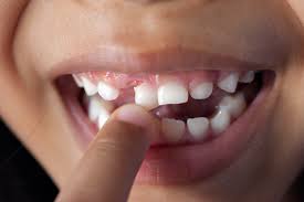 Open for more info it's become sort a tradition in my family for me to pull my niece, lana's, loose baby teeth. 6 Tips For Dealing With A Loose Tooth Port Pediatric Dentistry