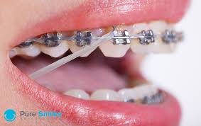 Learn how to eat with braces and rubber bands. The Importance Of Elastic Wear During Orthodontic Treatment