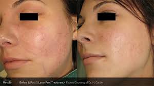 Both of these lasers also have a 1064 nm module. Aesthetic Clinic Skin Clinic Yuma Yuma Laser Center