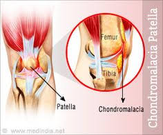 Chondromalacia