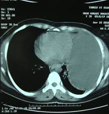More than one half of these massive pleural effusions are caused by malignancy; A Pitfall In The Diagnosis Of Giant Bronchogenic Cyst Presented As Loculated Pleural Effusion Heart Lung And Circulation