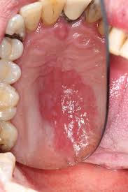 Image result for Erythroplakia roof of mouth