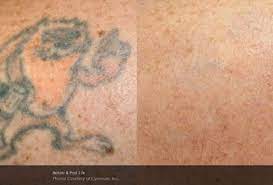 So far i am loving the results! Tattoo Removal East Bay San Jose Pleasanton Hayward Tracy