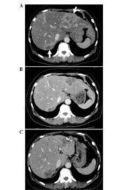 A pelvic ct scan can be used to detect several types of cancer. A Abdominal Ct Scan Of A 43 Year Old Female With Right Sided Breast Download Scientific Diagram