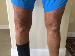 Pin On Knee Pain