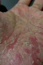 Once the blisters dry and flake off, which when to see a doctor. Dyshidrotic Eczema Symptoms Causes And Treatment