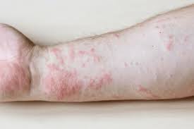 Image result for dermatitis contacta allergica