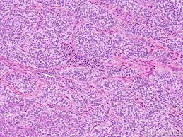 Image result for Glomus tumor