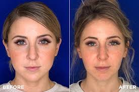 Very wide face with chubby cheeks and. Two Procedures For Slimming Down A Round Face Madnani Facial Plastics