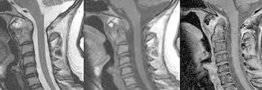 Mr tan hang chong is a professional nature guide and an enthusiastic nature lover. Spondyloarthritis Bei Isolierten Hws Beschwerden Nach Entzundungen Fahnden Medical Tribune