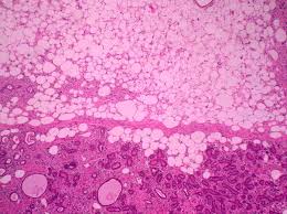 Phyllodes tumors are rare breast lesions of fibroepithelial origin. Malignant Phyllodes Tumor With Heterologous Liposarcomatous Differentiation And Tubular Adenoma Like Epithelial Component