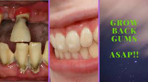 Receding Gums And The Shocking Truth Is It Even Possible To Reverse R Receding Gums Reverse Receding Gums Gum