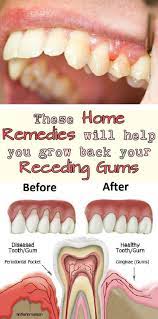 This Is How You Can Remove Tartar From Your Teeth And Have A Hollywood Smile Receding Gums Healthy Teeth Swollen Gum