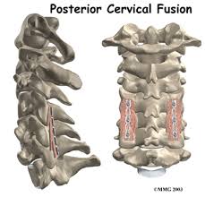 Shoulder—made up of the scapula and the humerus. Physical Therapy In Fort Collins For Posterior Cervical Fusion Surgery