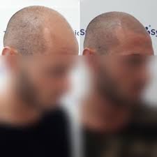 Trapianto di capelli a torino: Centro Trapianto Capelli Milano Trico System