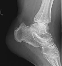 This condition is often precipitated by wearing shoes with rigid backs that rub against the heel. Haglund Deformity Radiology Reference Article Radiopaedia Org