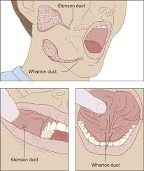 Image result for Sialolithiasis