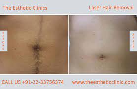 Pay per session laser treatments. Laser Hair Removal Mumbai Permanent Hair Removal Treatment Cost India The Esthetic Clinics