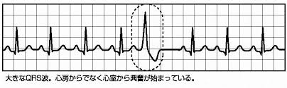 Psvtは 水平な基線の上に,aflは 粗動波の 上にqrsが 乗っていることをイメージして基線 を確認します。基線水平部があればpsvt,粗 動波が確認されればaflと 読みます。それでも 心電図診断が不明な場合 （ここからは医師の範 ä¸æ•´è„ˆ ã‚·ãƒ§ãƒ¼ãƒˆãƒ©ãƒ³ã«ã¤ã„ã¦ åŒ»æ•™ã‚³ãƒŸãƒ¥ãƒ‹ãƒ†ã‚£ ã¤ã¼ã¿ã‚¯ãƒ©ãƒ–