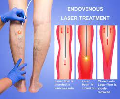 Endovenous Laser Treatment Evlt Surekha Varicose Veins Clinic Laser Treatment Fo Varicose Veins Venous Leg Ulcers Spider Veins
