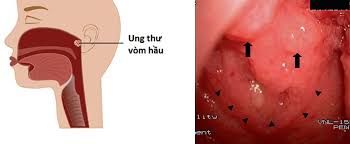 Maybe you would like to learn more about one of these? Cac Dáº¥u Hiá»‡u Giup Cháº©n Ä'oan Sá»›m Ung ThÆ° Vom Há»ng