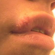 I'm currently seeing this guy who knows i have hsv2 and he said it doesn't change anything but he did ask me for stats. Herpes Pictures