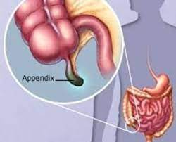 Later zakt de pijn in de buik naar de rechteronderkant van de buik. Blindedarmontsteking Appendicitis