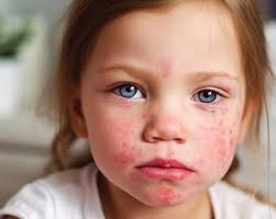 How Parents of Kids with Food Allergies Can Support Nonallergic Siblings