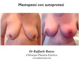 Foto Mastopessi Napoli | Dr. Raffaele Rauso