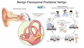 Image result for Canalith Repositioning Procedure